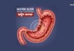 গ্যাস্ট্রিক আলসারের লক্ষণ ও চিকিৎসা