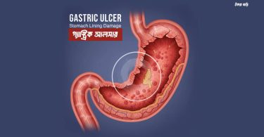গ্যাস্ট্রিক আলসারের লক্ষণ ও চিকিৎসা