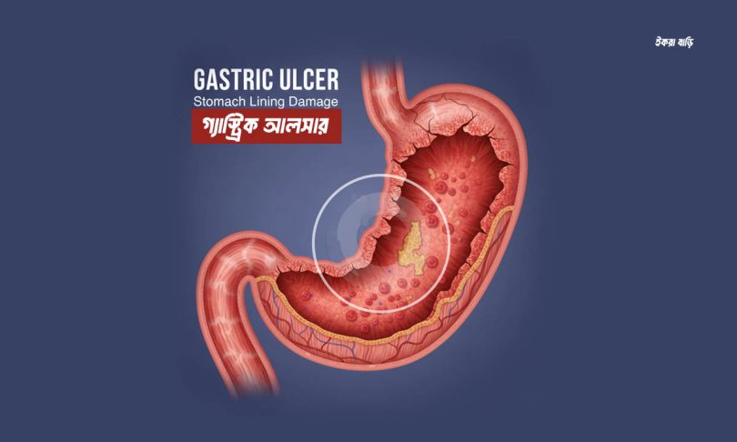 গ্যাস্ট্রিক আলসারের লক্ষণ ও চিকিৎসা